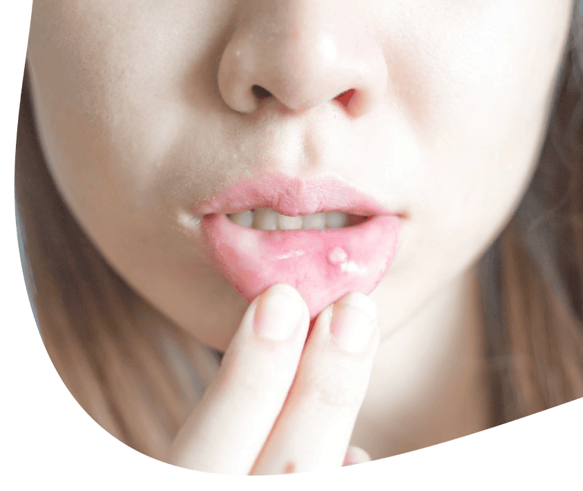 Mladá žena přitiskne prst na opar na spodním rtu.